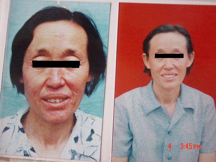 中州藥膏使用前后對比6