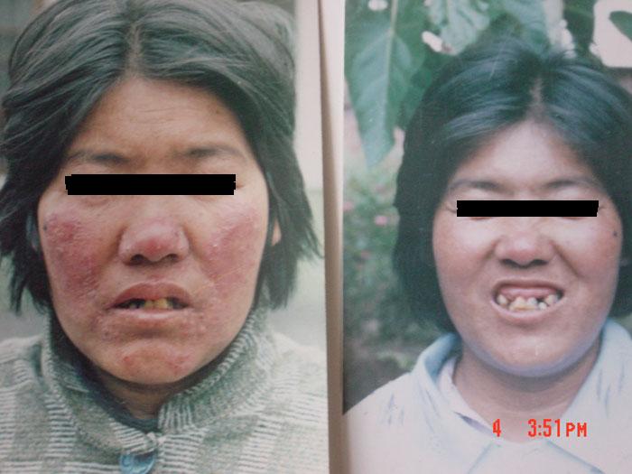 中州藥膏使用前后對比2