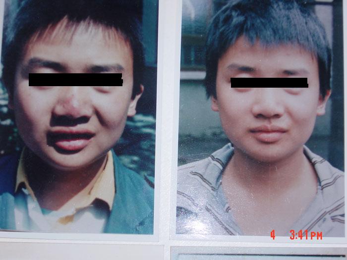 中州藥膏使用前后對比