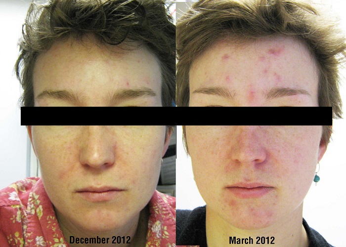 中州藥膏使用前后對比